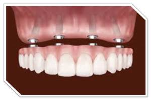 dental implants chicago